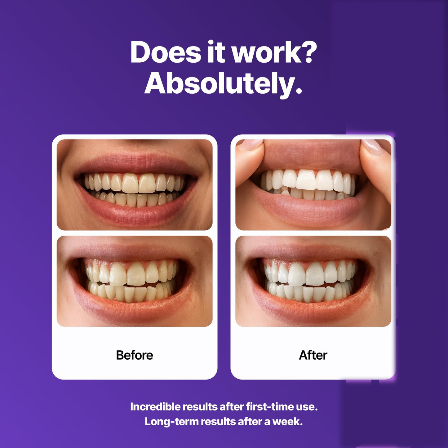 Frontanium Teeth Whitening Strips